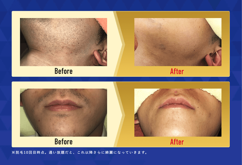 ヒゲ脱毛でこれだけ変わります！
