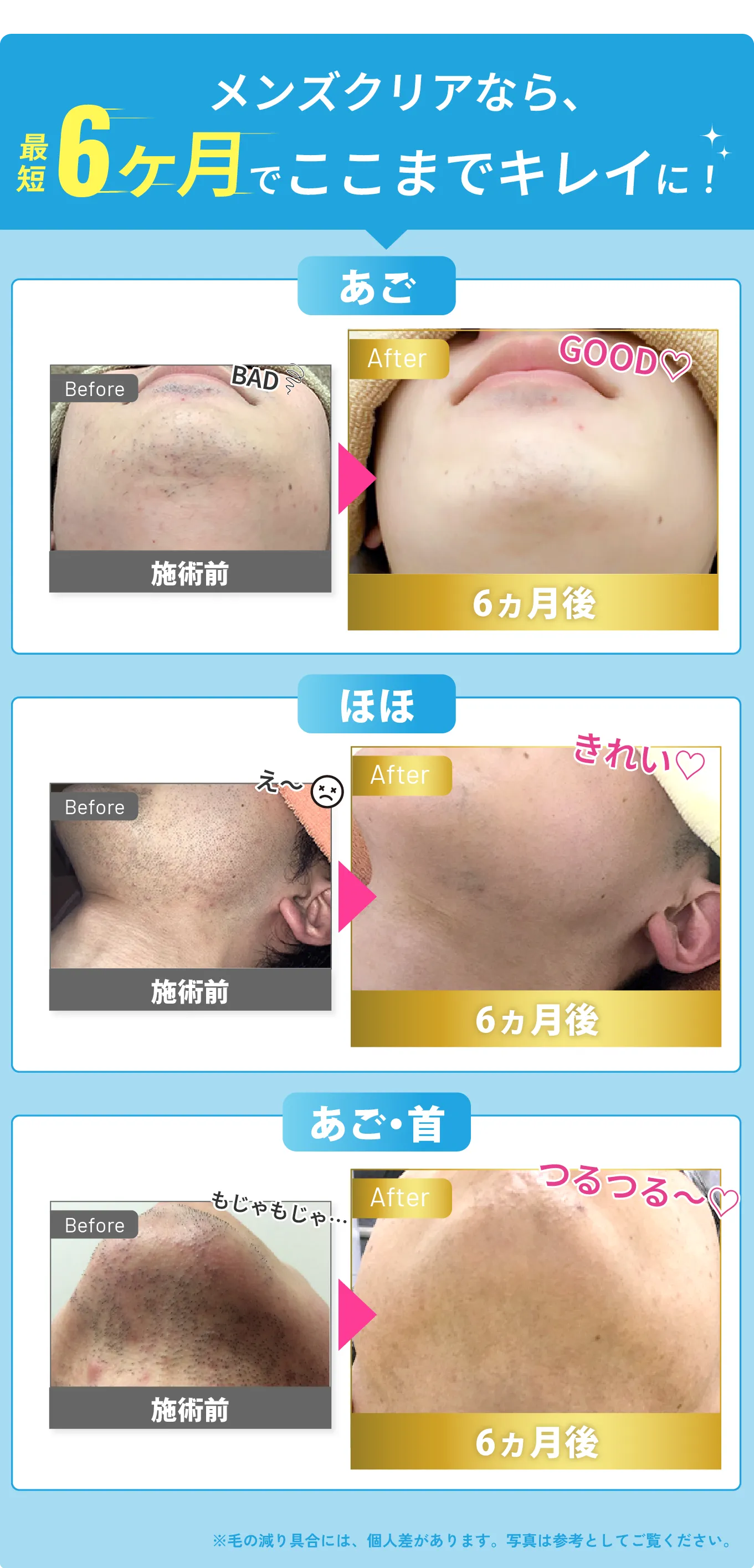 メンズクリアなら 最短6ヶ月でここまでキレイに!