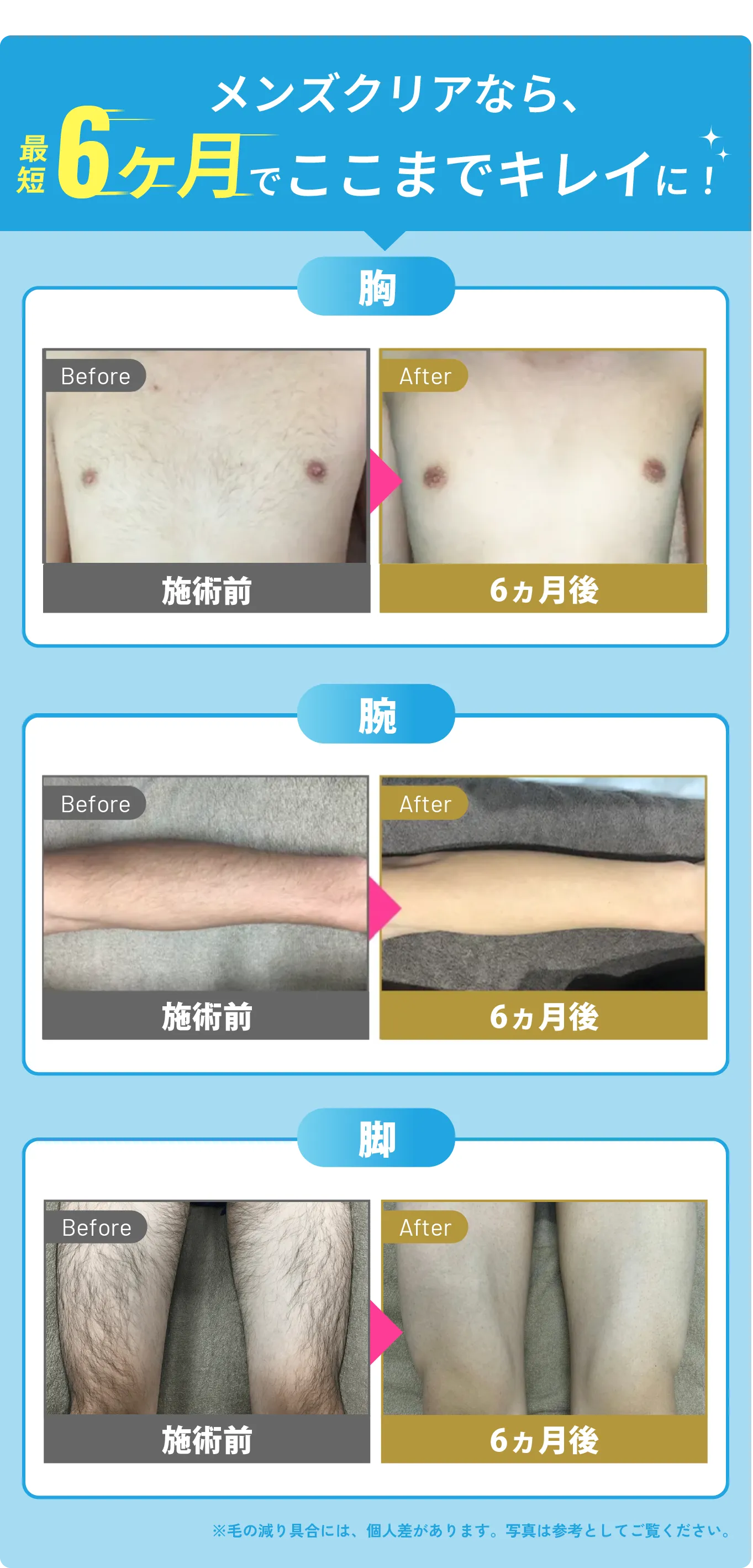 メンズクリアなら 最短6ヶ月でここまでキレイに!