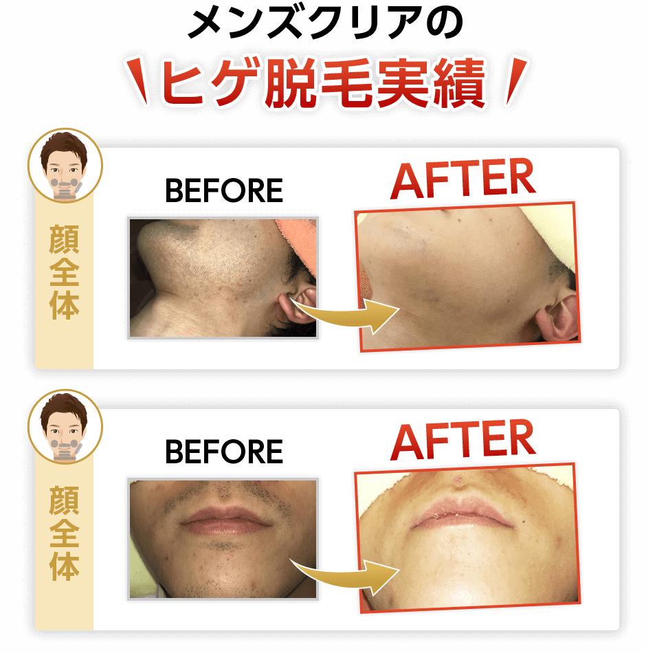 気になる青髭も…こんなに変わります！