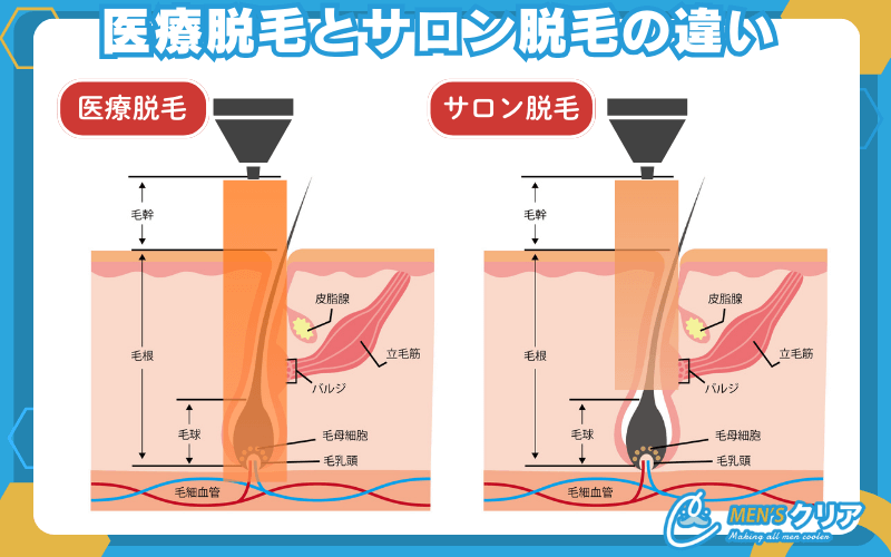 ヒゲ脱毛_医療脱毛_サロン脱毛_違い