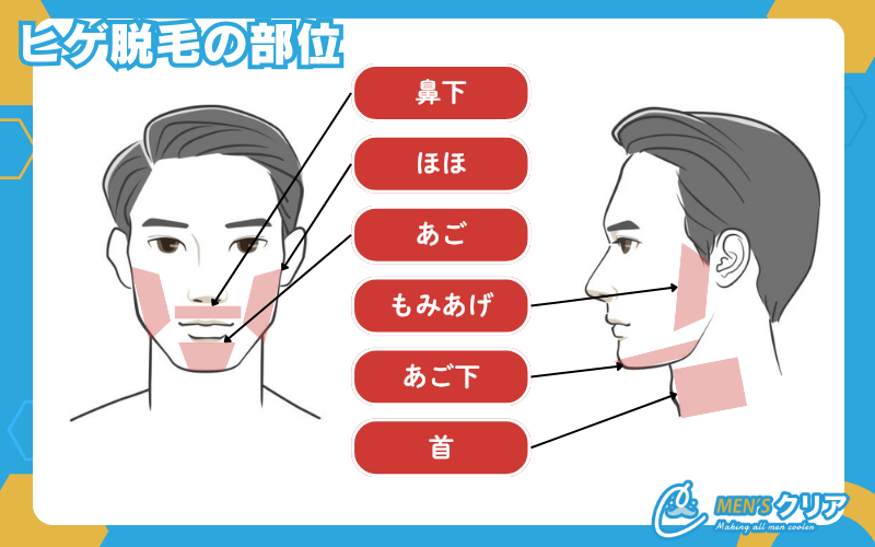 医療脱毛_ヒゲ脱毛の部位