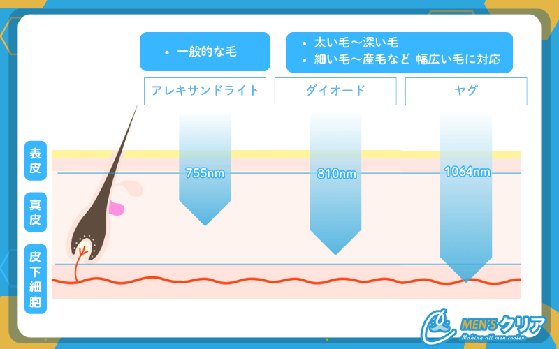 医療脱毛_レーザーの違い