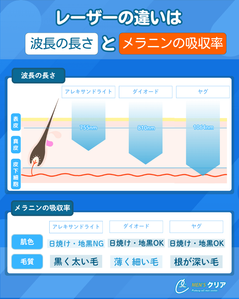 メンズ医療脱毛_おすすめ_レーザーの種類