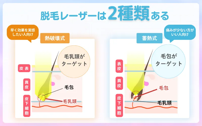 医療脱毛_レーザーの種類