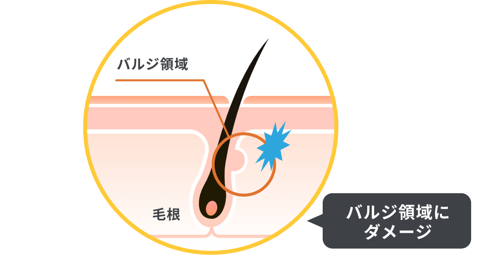 バルジ領域にダメージ