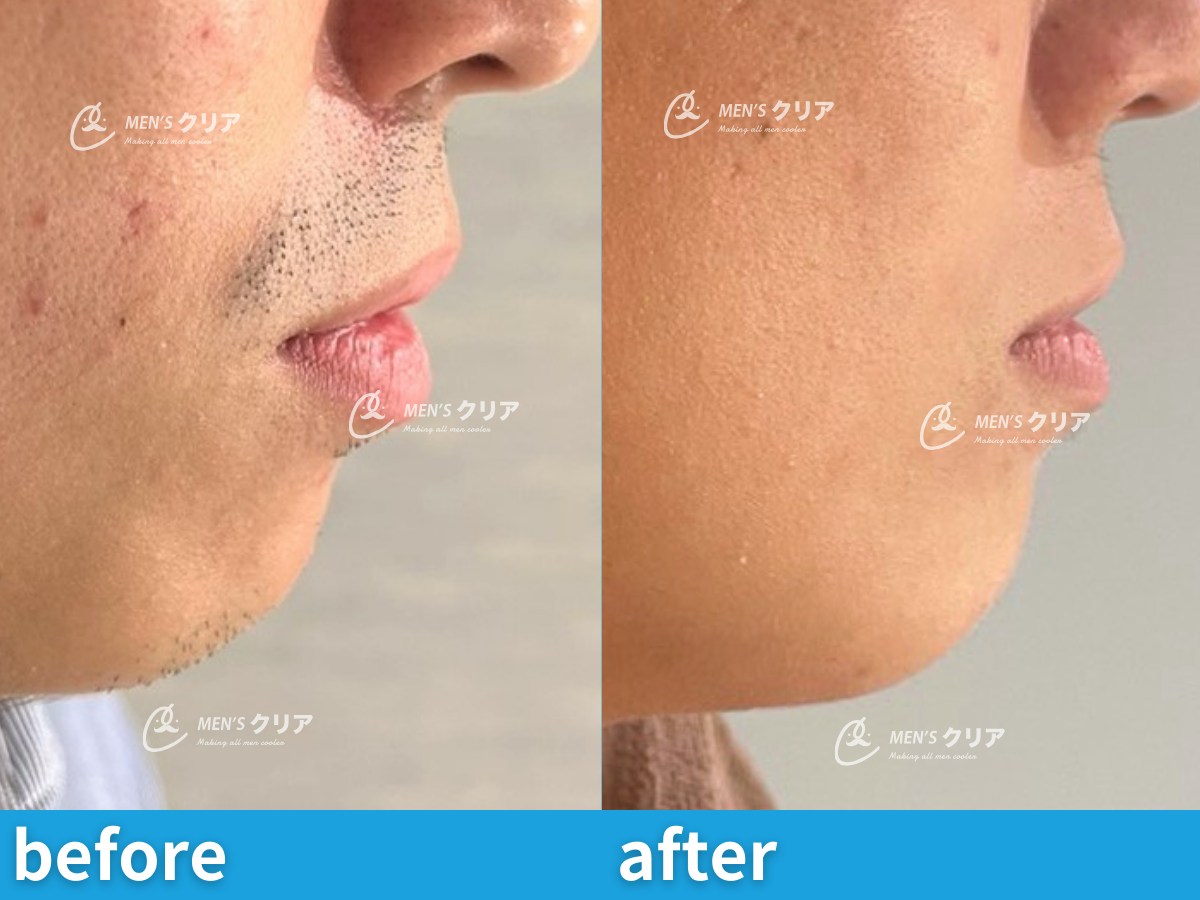 ヒゲ脱毛トライアル