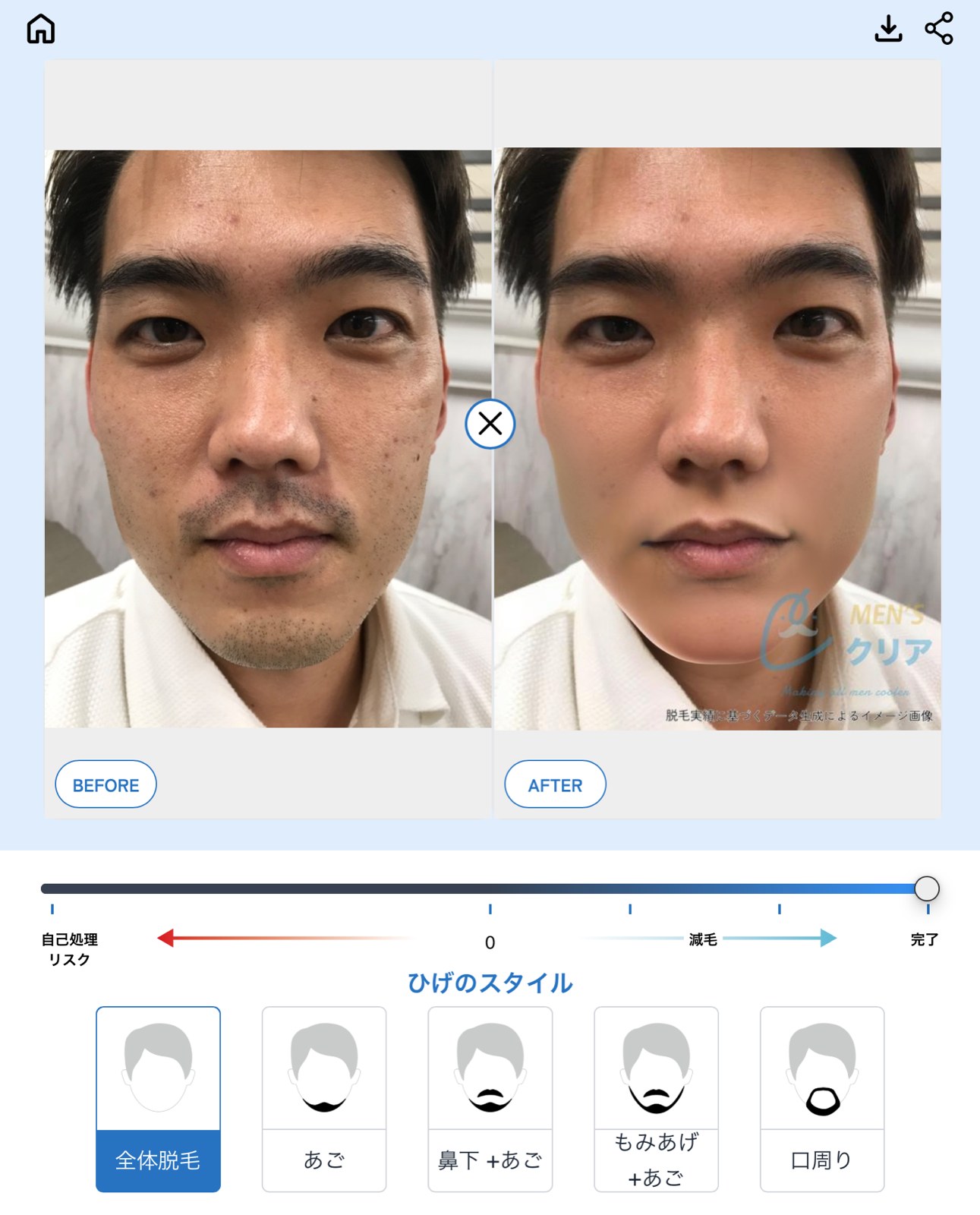 脱毛AIシミュレーター画面例（20代男性イメージ）