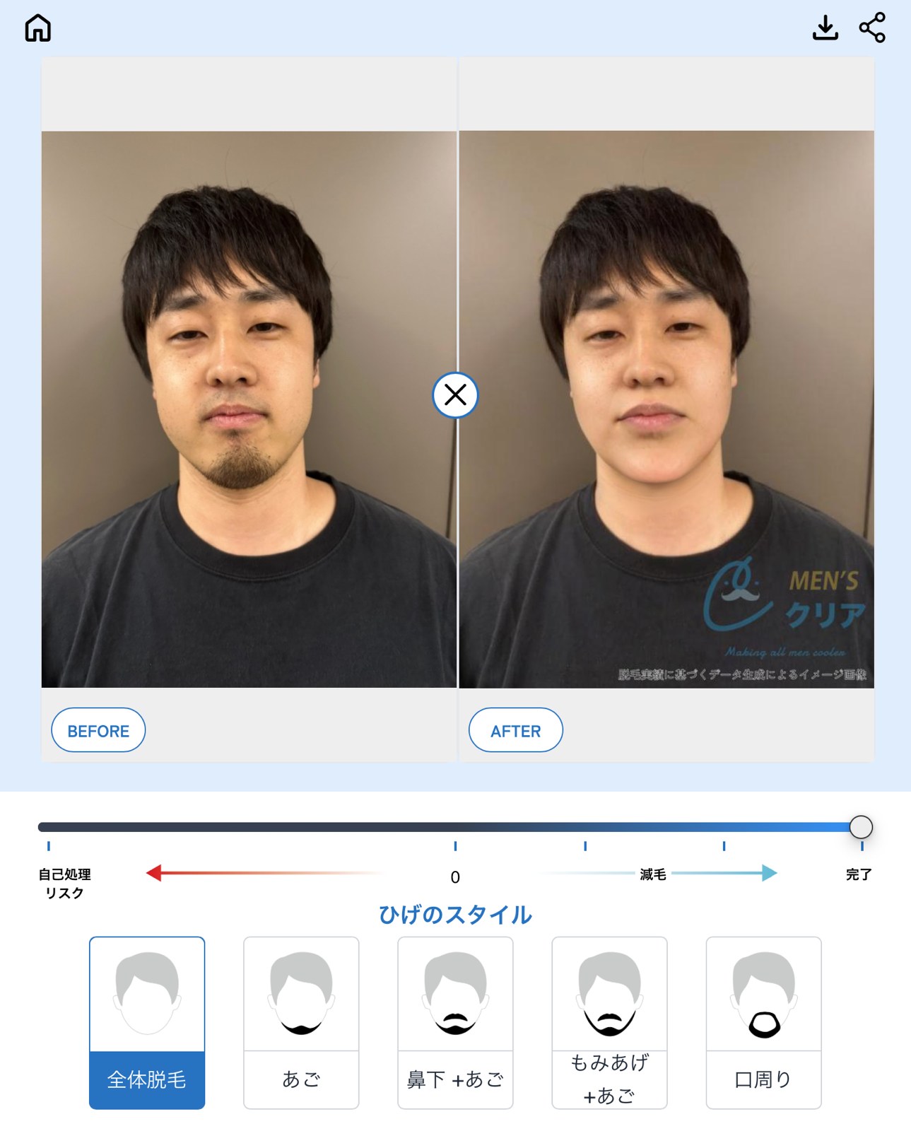 脱毛AIシミュレーター画面例（30代男性イメージ）