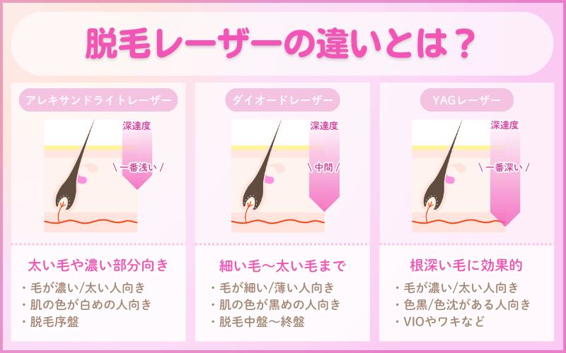 医療脱毛_脱毛レーザー_違い