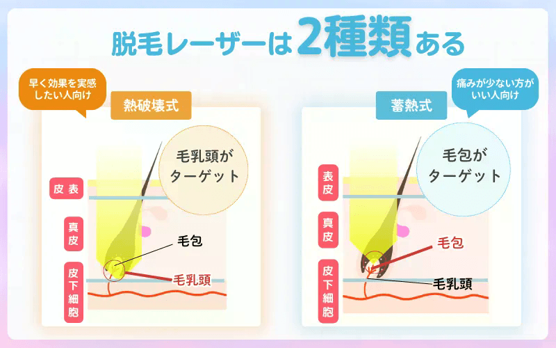 医療脱毛_レーザーの種類